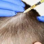 育毛メソセラピーの施術内容・効果